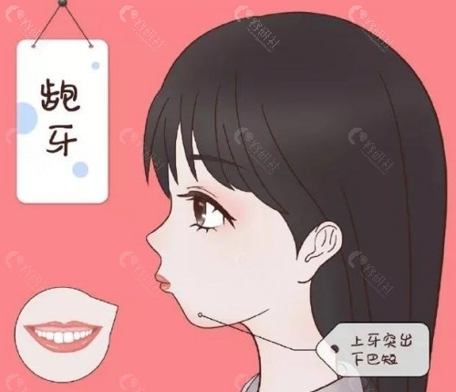 骨性与牙性前突的区别
