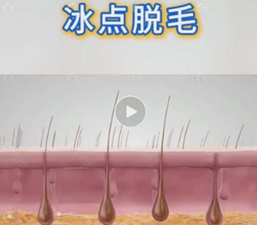 冰点脱毛和激光脱毛哪个好