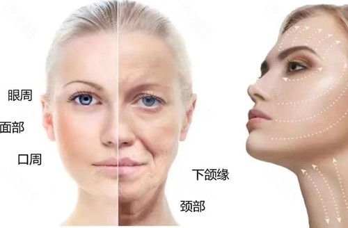 5D胶原光和热玛吉光子嫩肤哪个好