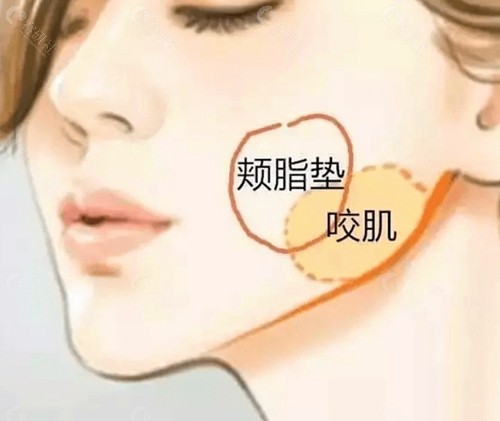 颊脂垫取了之后还能填上吗？