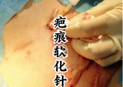 疤痕软化针一般打几次有效果