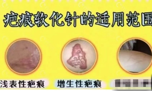 疤痕软化针和激光祛疤哪个好