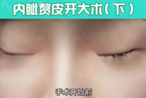 2025内眦赘皮矫正术收费价格表及影响因素
