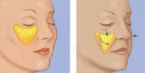苹果肌复位20天了皱纹还在是不是手术失败了？