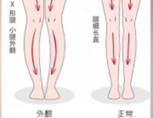 腿型矫正价格