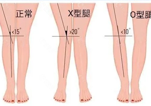 o形腿和x型腿的区别有哪些？