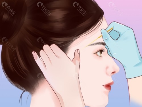 玻尿酸填充太阳穴怎么样？