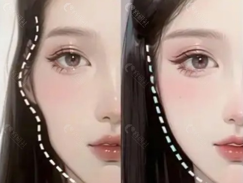 自体脂肪填充太阳穴好不好？