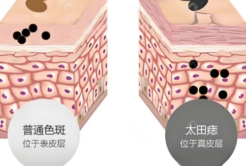太田痣怎么去除？