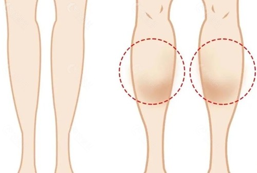正规瘦腿针多少钱