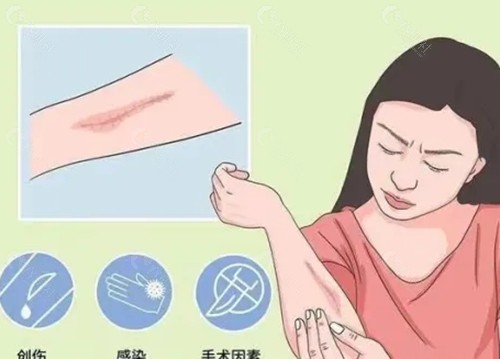 胶原蛋白对疤痕修复有用吗