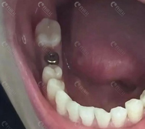 如何避免种植牙后悔情况发生？