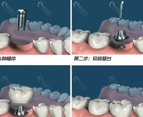 韩国种植牙哪种品牌好