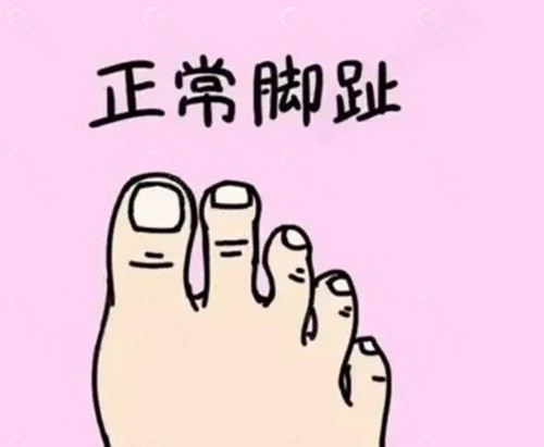 二脚趾缩短手术多久可以正常走路？