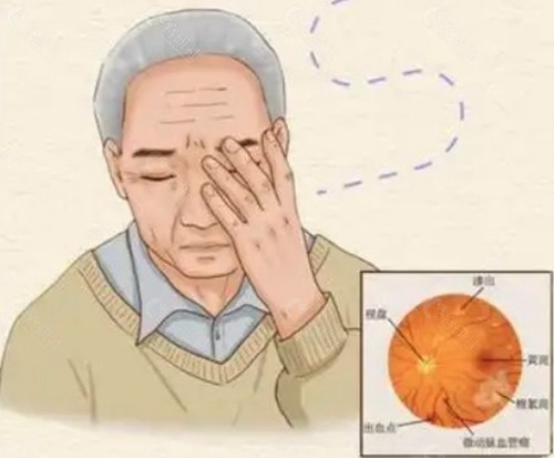 哪些情况下医生不建议做眼底检查？