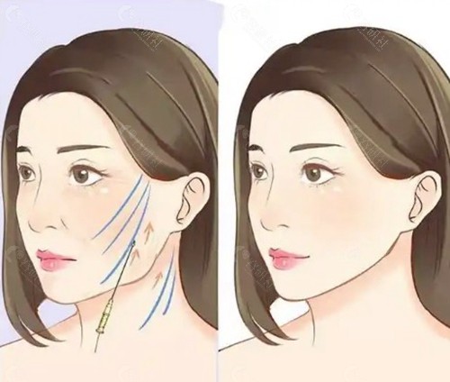 面部复位提拉术的操作流程