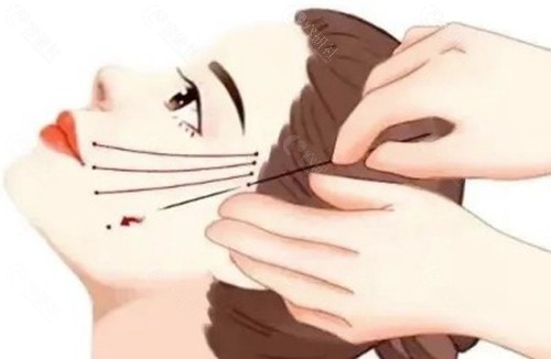 埋线提升：物理提拉轮廓