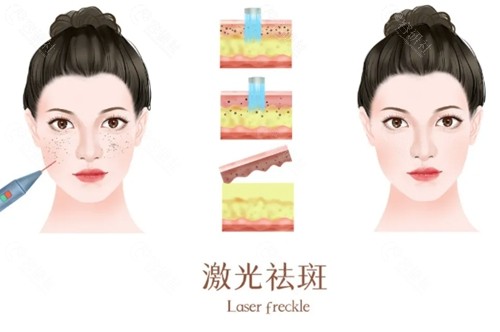 西宁伊美莱激光祛斑怎么样