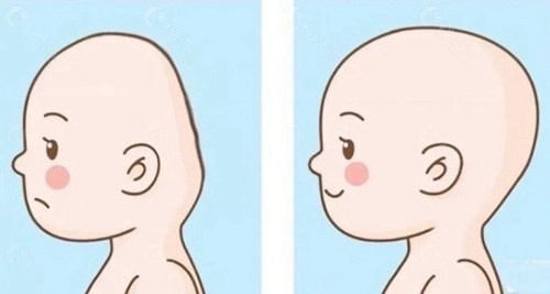 扁头填充手术的基本原理