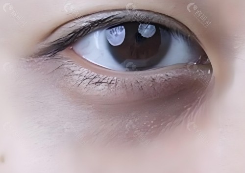 皮秒去黑眼圈成效好不好？