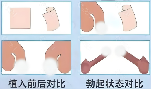 生物补片增粗手术价格是多少？