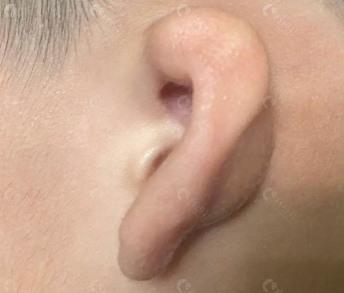 宝宝6种常见耳朵畸形