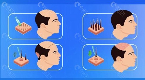 4000个毛囊能植发多大面积？