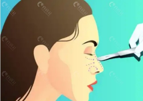 赫本鼻是什么意思？填充的是什么材质？