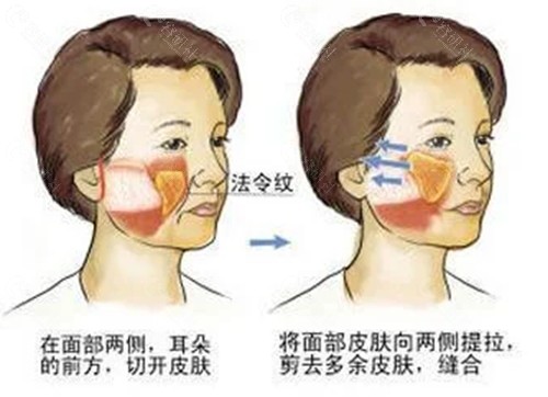 保定拉皮手术价格