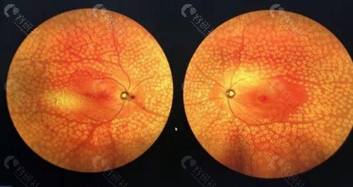 为什么有人建议尽量避免视网膜光凝术？