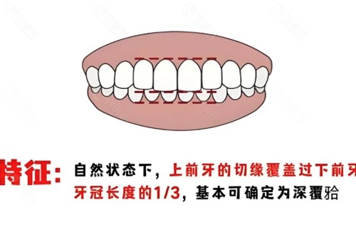 深覆合矫正价格