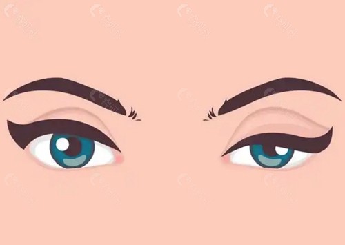 上睑下垂额肌瓣悬吊术多久能闭上眼睑？