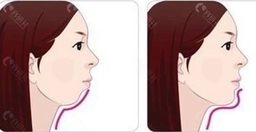 选择哪种下颌角削骨手术方法更好