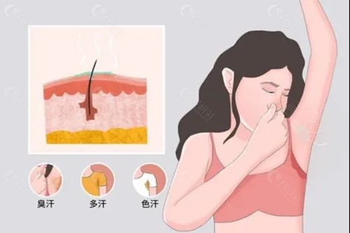 狐臭选微创还是激光好