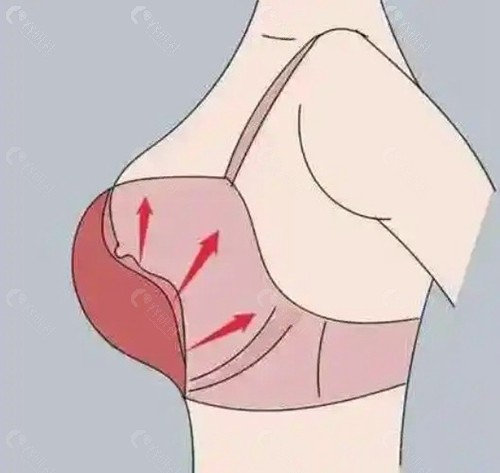 不开刀人工韧带乳房提升术的原理