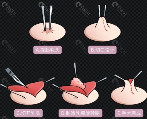 乳头整形手术价格贵吗？