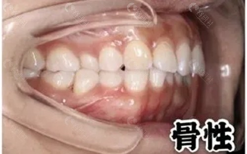 骨性凸嘴矫正会不会反弹