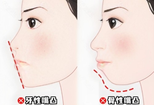 骨性嘴凸正颌一般得多少钱？