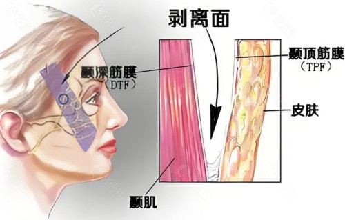 筋膜复位术跟筋膜提升到底咋选？