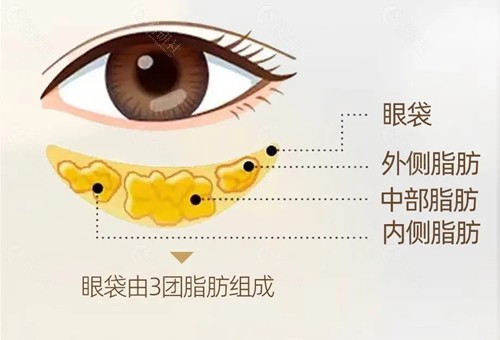 7d不开刀去眼袋原理