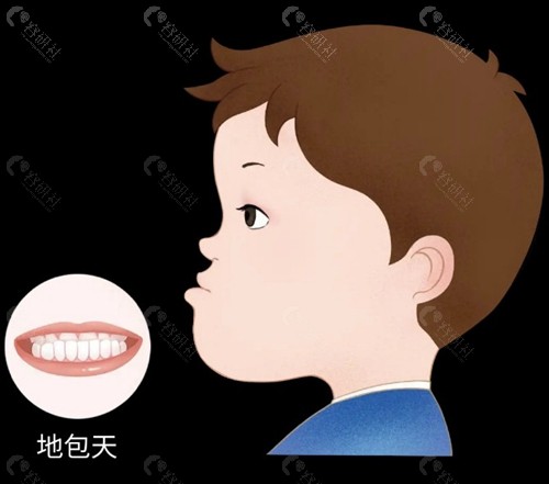 12岁骨性地包天戴哪个合适