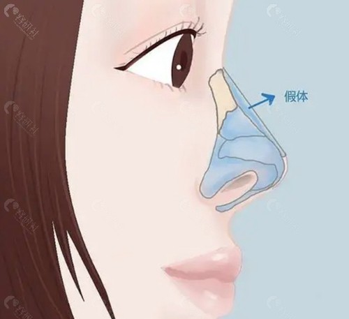 立秀膨体隆鼻后鼻子会透光吗？