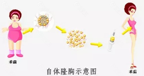 自体脂肪丰胸结节怎么办