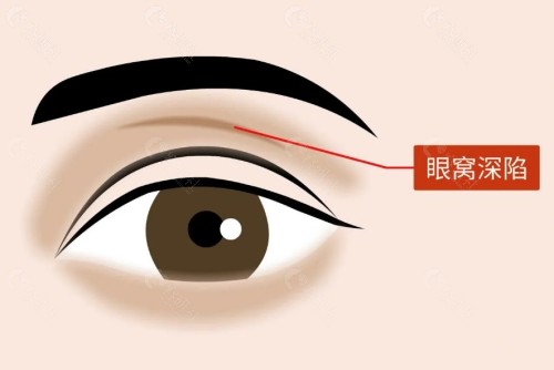 眼窝凹陷填充胶原蛋白能保持多久？