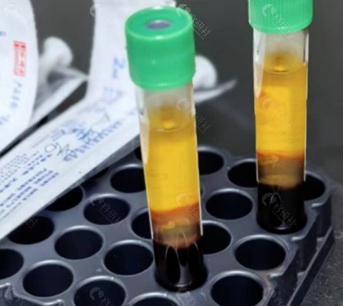 cgf治疗脱发一旦使用了真的就不能停吗？
