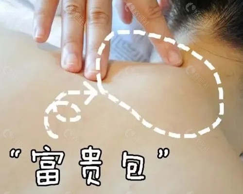 富贵包可以打溶脂针消除吗？