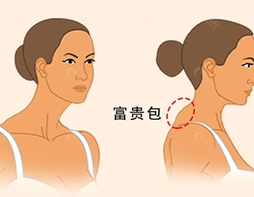 富贵包吸脂会不会反弹