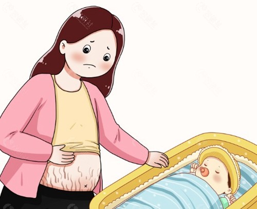 激光去妊娠纹做几次才有效？