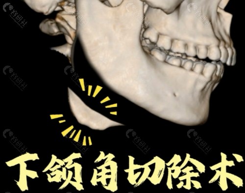 下颌角切除过多能用金属支架吗？