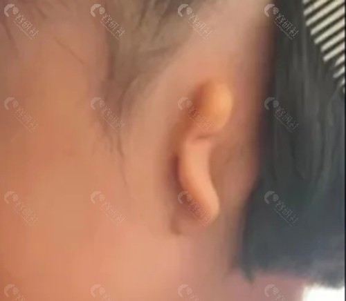 耳朵整形手术能报销吗